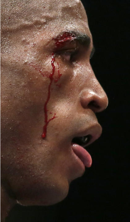 Erislandy Lara, of Cuba, bleeds from his right eye during their super welterweight fight against Canelo Alvarez, Saturday, July 12, 2014, in Las Vegas