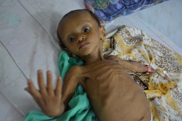 聯合國說，光是荷台達省就有10萬名5歲以下幼兒瀕臨餓死。（美聯社）