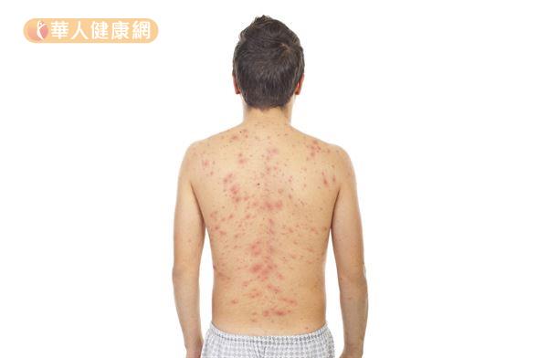 中醫師周宗翰表示，背部容易長痘痘的人，通常屬於濕氣較重的體質。
