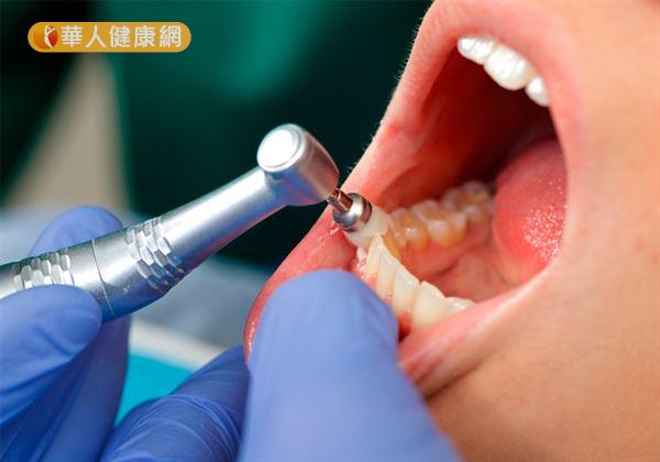 透過定期的「洗牙」，不僅有助預防及治療牙周病。同時，也有幫助檢查口腔健康有無異狀的功用。