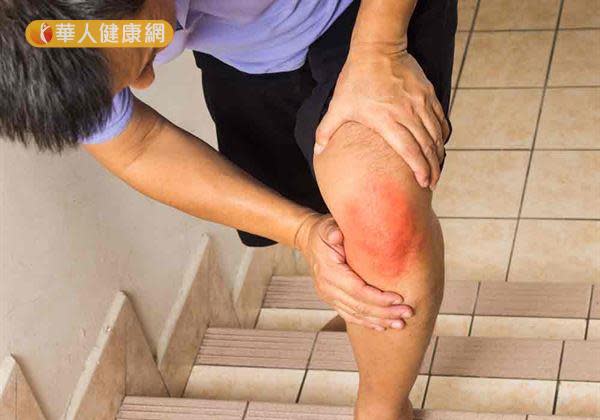 爬樓梯雖有助增強心肺功能、消耗熱量，但卻屬於負重運動，容易造成膝關節磨損。